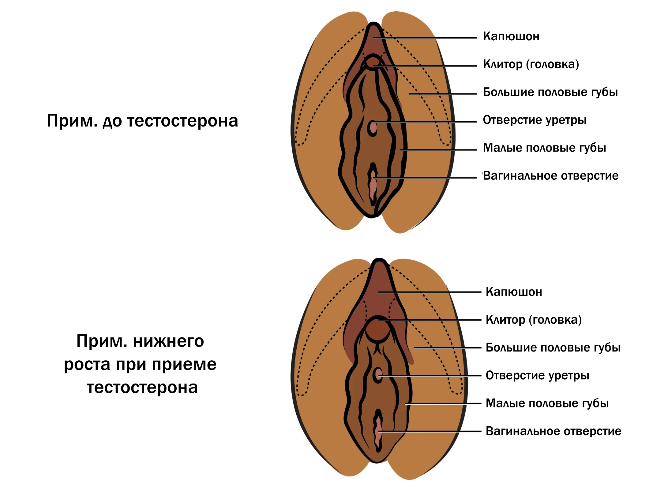 диаграмма нижнего роста клитора до и после ЗГТ с тестостероном